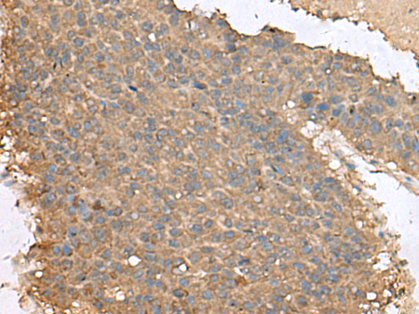 Immunohistochemistry of paraffin-embedded Human liver cancer tissue  using FAM19A4 Polyclonal Antibody at dilution of 1:65(×200)