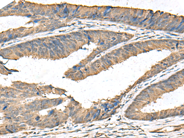 Immunohistochemistry of paraffin-embedded Human colorectal cancer tissue  using FAM19A4 Polyclonal Antibody at dilution of 1:65(×200)