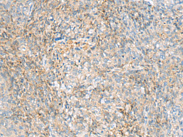 Immunohistochemistry of paraffin-embedded Human cervical cancer tissue  using HBZ Polyclonal Antibody at dilution of 1:80(×200)