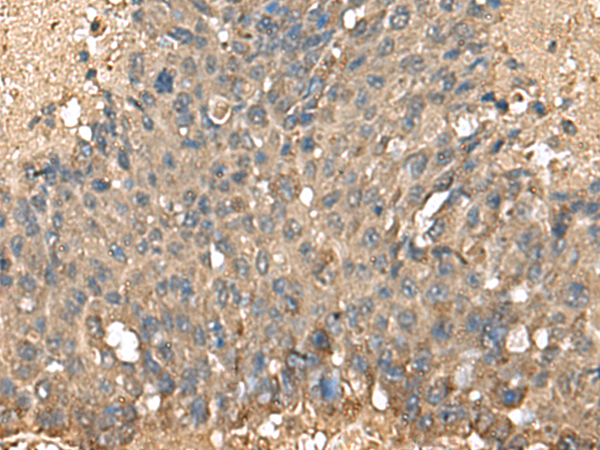 Immunohistochemistry of paraffin-embedded Human liver cancer tissue  using MRPL42 Polyclonal Antibody at dilution of 1:60(×200)