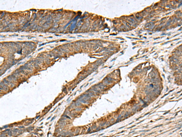 Immunohistochemistry of paraffin-embedded Human colorectal cancer tissue  using MRPL42 Polyclonal Antibody at dilution of 1:60(×200)