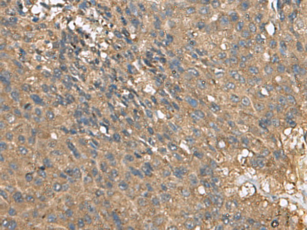 Immunohistochemistry of paraffin-embedded Human liver cancer tissue  using EIF1AX Polyclonal Antibody at dilution of 1:105(×200)