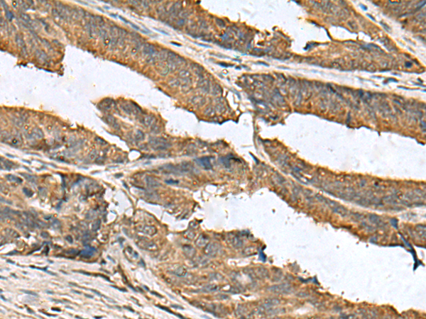 Immunohistochemistry of paraffin-embedded Human colorectal cancer tissue  using EIF1AX Polyclonal Antibody at dilution of 1:105(×200)