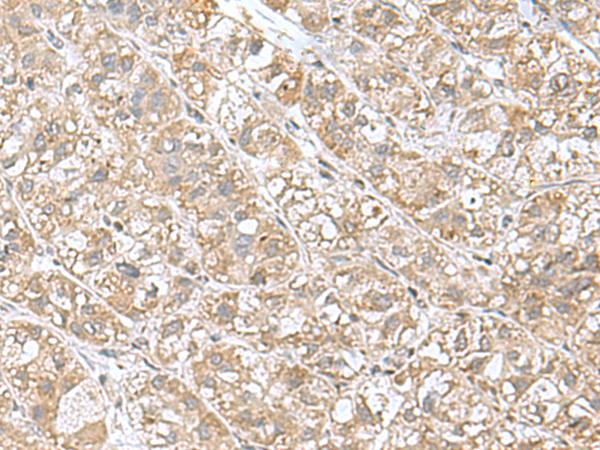 Immunohistochemistry of paraffin-embedded Human liver cancer tissue  using EIF1AY Polyclonal Antibody at dilution of 1:55(×200)