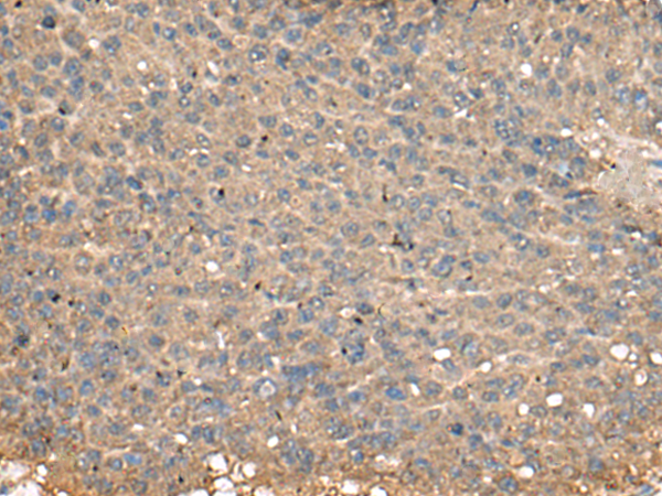 Immunohistochemistry of paraffin-embedded Human liver cancer tissue  using PLA2G2A Polyclonal Antibody at dilution of 1:55(×200)