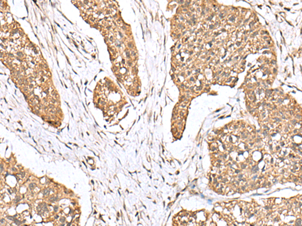 Immunohistochemistry of paraffin-embedded Human esophagus cancer tissue  using PLA2G2A Polyclonal Antibody at dilution of 1:55(×200)