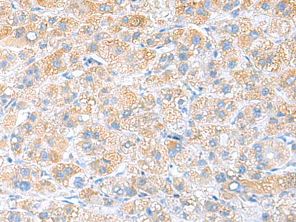 Immunohistochemistry of paraffin-embedded Human liver cancer tissue  using RPS16 Polyclonal Antibody at dilution of 1:65(×200)