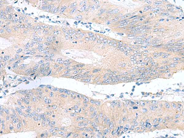 Immunohistochemistry of paraffin-embedded Human colorectal cancer tissue  using RPS16 Polyclonal Antibody at dilution of 1:65(×200)