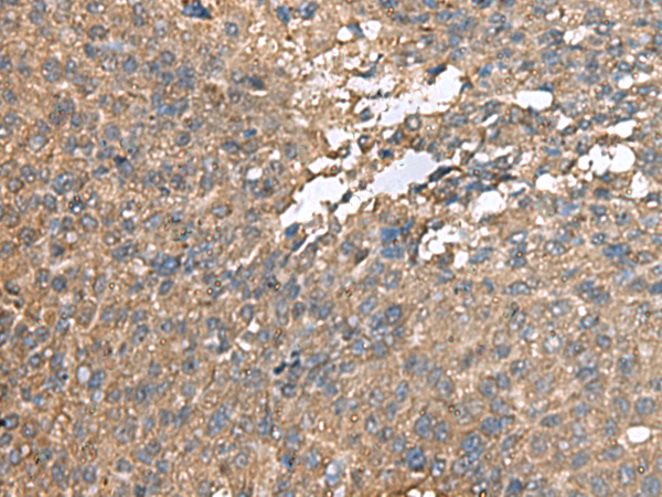 Immunohistochemistry of paraffin-embedded Human liver cancer tissue  using AHNAK Polyclonal Antibody at dilution of 1:100(×200)