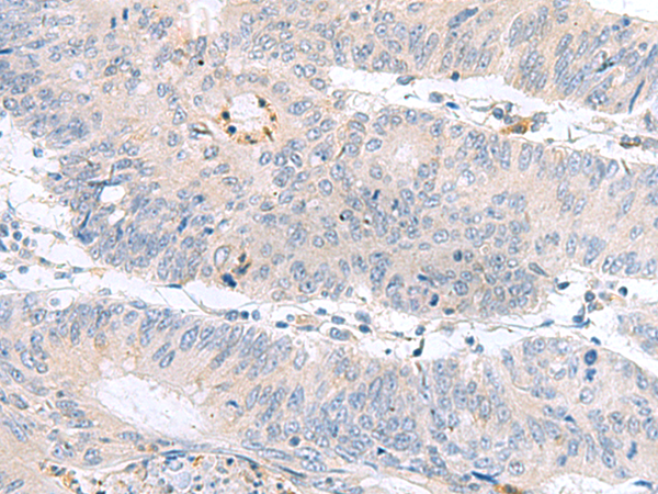 Immunohistochemistry of paraffin-embedded Human colorectal cancer tissue  using PDE6D Polyclonal Antibody at dilution of 1:60(×200)