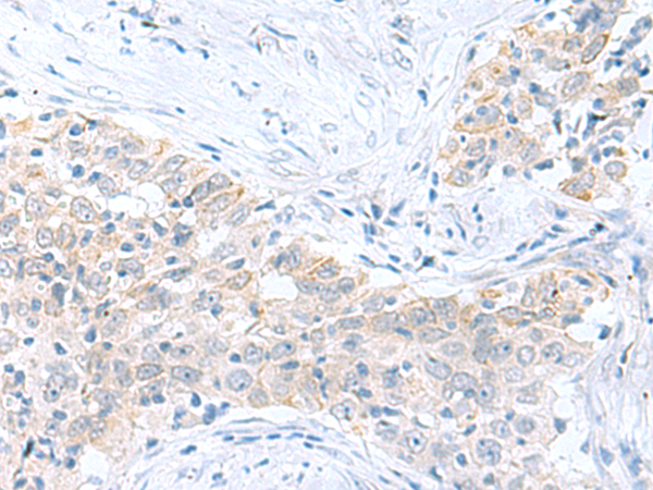 Immunohistochemistry of paraffin-embedded Human esophagus cancer tissue  using PDE6D Polyclonal Antibody at dilution of 1:60(×200)