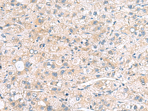 Immunohistochemistry of paraffin-embedded Human liver cancer tissue  using MYL1 Polyclonal Antibody at dilution of 1:75(×200)