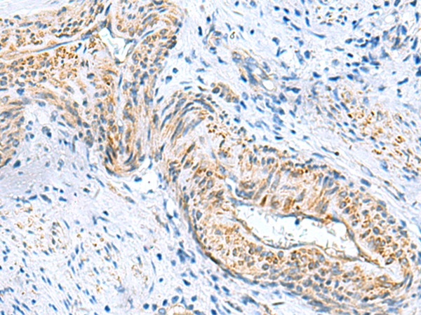 Immunohistochemistry of paraffin-embedded Human cervical cancer tissue  using MYL1 Polyclonal Antibody at dilution of 1:75(×200)