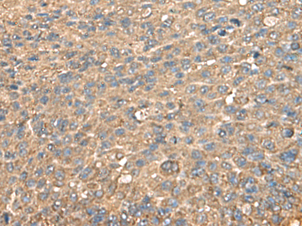 Immunohistochemistry of paraffin-embedded Human liver cancer tissue  using RPS14 Polyclonal Antibody at dilution of 1:60(×200)