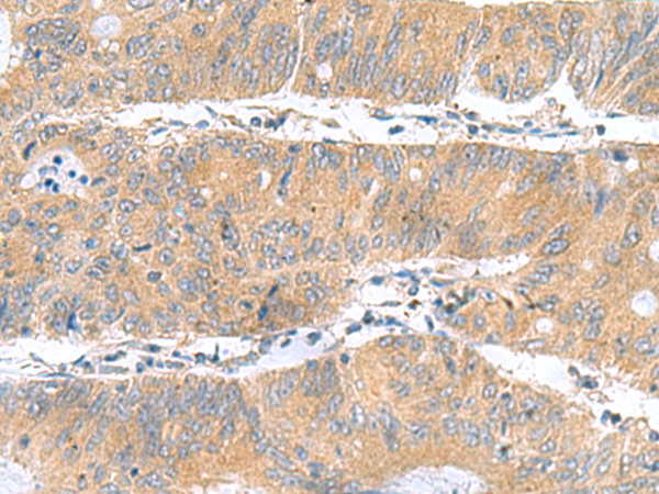 Immunohistochemistry of paraffin-embedded Human colorectal cancer tissue  using DNAL1 Polyclonal Antibody at dilution of 1:50(×200)