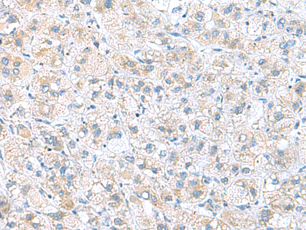 Immunohistochemistry of paraffin-embedded Human liver cancer tissue  using DNAL1 Polyclonal Antibody at dilution of 1:50(×200)