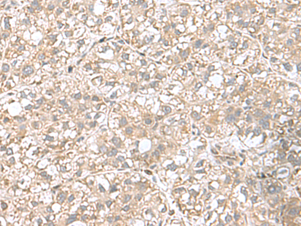 Immunohistochemistry of paraffin-embedded Human liver cancer tissue  using CPLX3 Polyclonal Antibody at dilution of 1:65(×200)