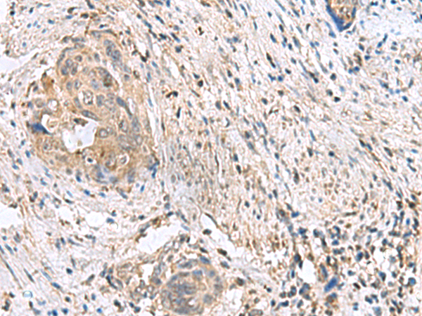 Immunohistochemistry of paraffin-embedded Human cervical cancer tissue  using STK32A Polyclonal Antibody at dilution of 1:90(×200)