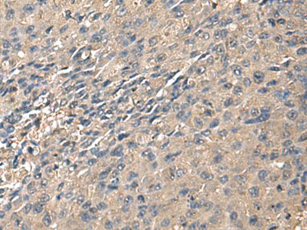 Immunohistochemistry of paraffin-embedded Human liver cancer tissue  using ZG16 Polyclonal Antibody at dilution of 1:95(×200)