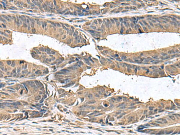 Immunohistochemistry of paraffin-embedded Human colorectal cancer tissue  using ZG16 Polyclonal Antibody at dilution of 1:95(×200)