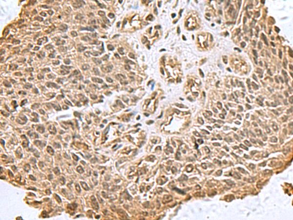 Immunohistochemistry of paraffin-embedded Human lung cancer tissue  using DCTPP1 Polyclonal Antibody at dilution of 1:80(×200)