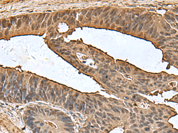 Immunohistochemistry of paraffin-embedded Human colorectal cancer tissue  using DCTPP1 Polyclonal Antibody at dilution of 1:80(×200)