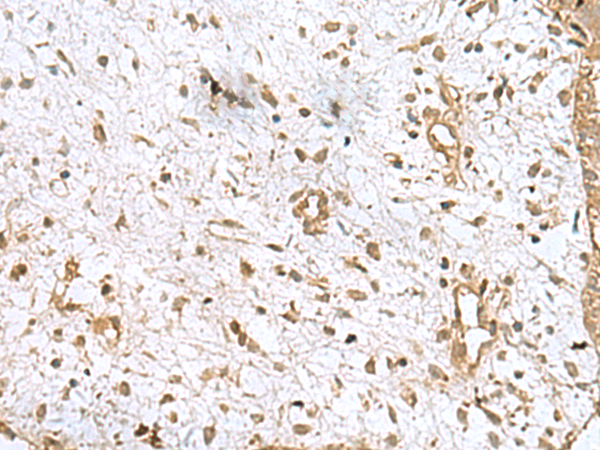 Immunohistochemistry of paraffin-embedded Human breast cancer tissue  using AK6 Polyclonal Antibody at dilution of 1:90(×200)