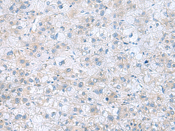 Immunohistochemistry of paraffin-embedded Human liver cancer tissue  using TXNDC12 Polyclonal Antibody at dilution of 1:60(×200)