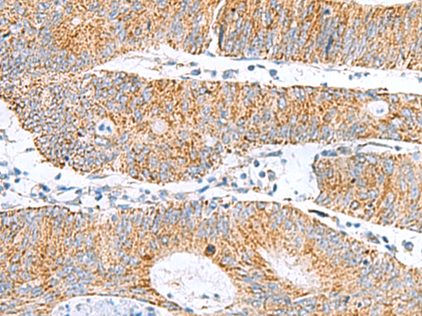 Immunohistochemistry of paraffin-embedded Human colorectal cancer tissue  using GCSH Polyclonal Antibody at dilution of 1:60(×200)