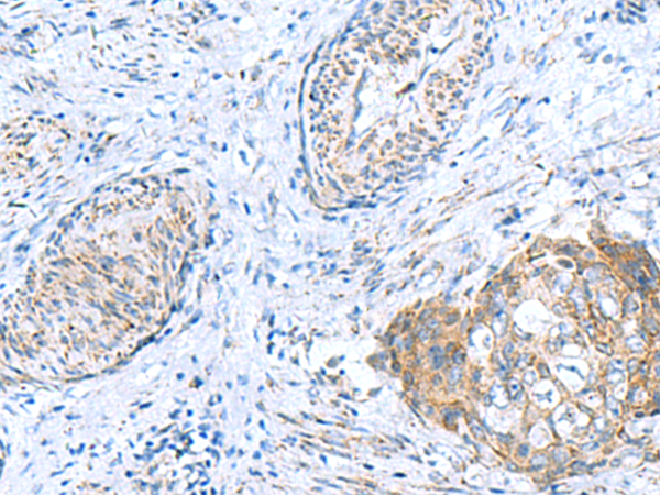 Immunohistochemistry of paraffin-embedded Human cervical cancer tissue  using GCSH Polyclonal Antibody at dilution of 1:60(×200)