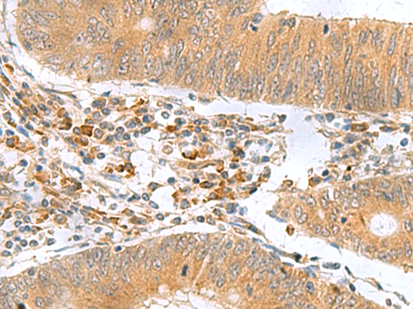 Immunohistochemistry of paraffin-embedded Human colorectal cancer tissue  using MYDGF Polyclonal Antibody at dilution of 1:65(×200)