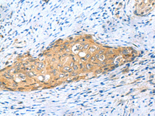 Immunohistochemistry of paraffin-embedded Human cervical cancer tissue  using MYDGF Polyclonal Antibody at dilution of 1:65(×200)