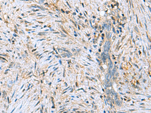 Immunohistochemistry of paraffin-embedded Human cervical cancer tissue  using DNPH1 Polyclonal Antibody at dilution of 1:55(×200)