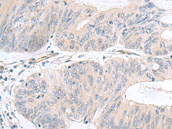 Immunohistochemistry of paraffin-embedded Human colorectal cancer tissue  using NMU Polyclonal Antibody at dilution of 1:60(×200)