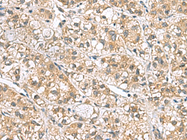 Immunohistochemistry of paraffin-embedded Human liver cancer tissue  using PPIH Polyclonal Antibody at dilution of 1:70(×200)