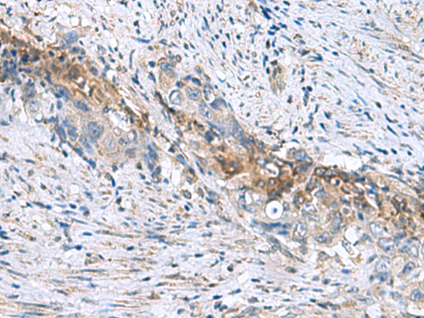 Immunohistochemistry of paraffin-embedded Human cervical cancer tissue  using RNF208 Polyclonal Antibody at dilution of 1:55(×200)