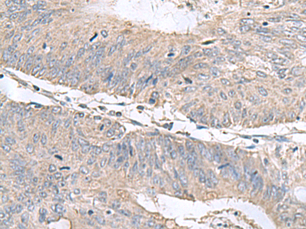 Immunohistochemistry of paraffin-embedded Human colorectal cancer tissue  using RNF208 Polyclonal Antibody at dilution of 1:55(×200)