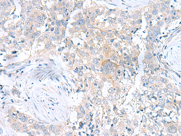 Immunohistochemistry of paraffin-embedded Human esophagus cancer tissue  using UBE2F Polyclonal Antibody at dilution of 1:100(×200)