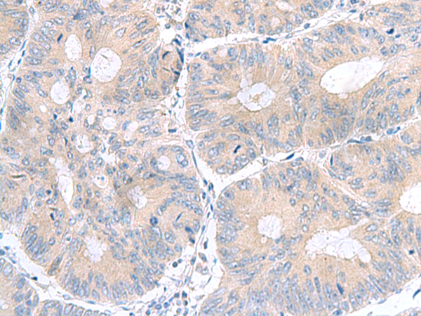 Immunohistochemistry of paraffin-embedded Human colorectal cancer tissue  using UBE2F Polyclonal Antibody at dilution of 1:100(×200)