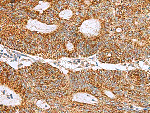 Immunohistochemistry of paraffin-embedded Human colorectal cancer tissue  using MRPS28 Polyclonal Antibody at dilution of 1:105(×200)