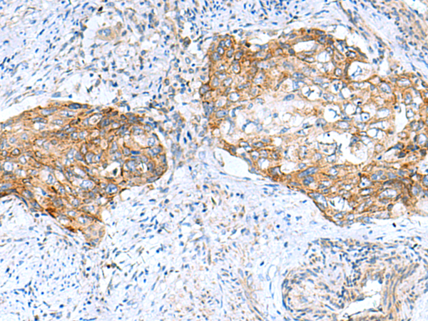 Immunohistochemistry of paraffin-embedded Human cervical cancer tissue  using MRPS28 Polyclonal Antibody at dilution of 1:105(×200)