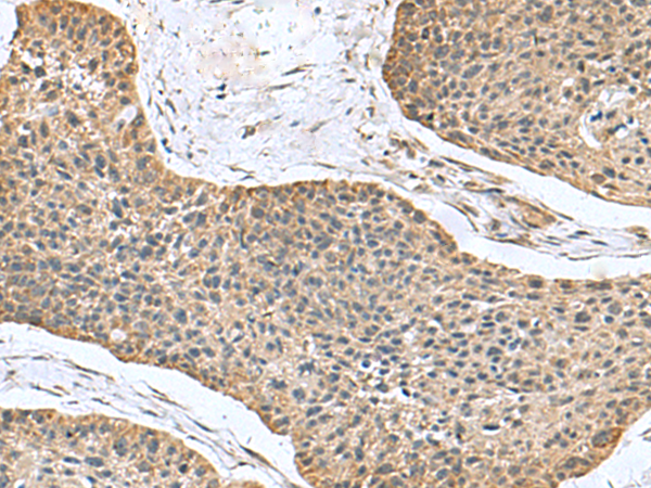 Immunohistochemistry of paraffin-embedded Human esophagus cancer tissue  using NFS1 Polyclonal Antibody at dilution of 1:100(×200)