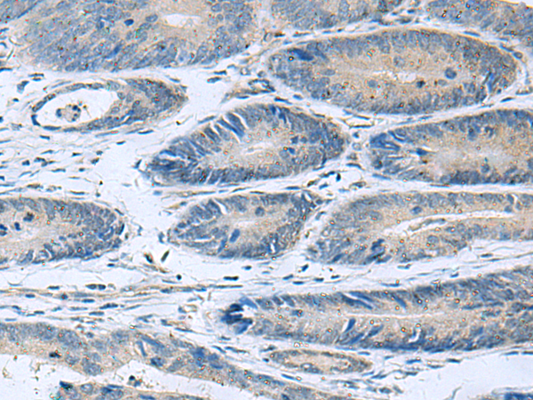 Immunohistochemistry of paraffin-embedded Human colorectal cancer tissue  using HPCAL1 Polyclonal Antibody at dilution of 1:90(×200)