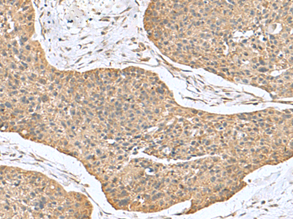 Immunohistochemistry of paraffin-embedded Human esophagus cancer tissue  using CSRP2 Polyclonal Antibody at dilution of 1:70(×200)