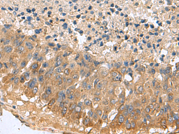 Immunohistochemistry of paraffin-embedded Human liver cancer tissue  using MARCKSL1 Polyclonal Antibody at dilution of 1:70(×200)