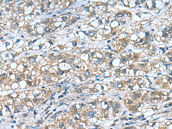 Immunohistochemistry of paraffin-embedded Human liver cancer tissue  using COMMD9 Polyclonal Antibody at dilution of 1:55(×200)