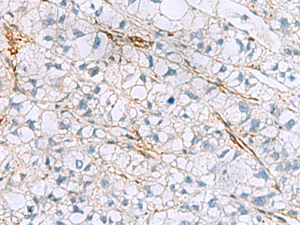 Immunohistochemistry of paraffin-embedded Human liver cancer tissue  using TAGLN3 Polyclonal Antibody at dilution of 1:60(×200)