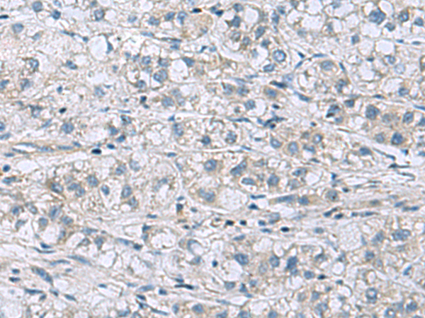 Immunohistochemistry of paraffin-embedded Human liver cancer tissue  using ITGB1BP1 Polyclonal Antibody at dilution of 1:60(×200)