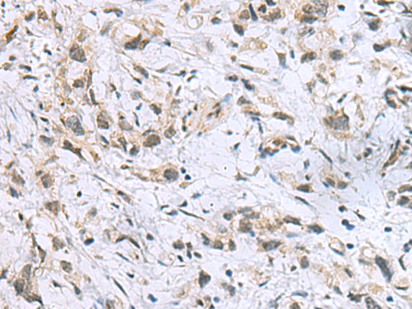 Immunohistochemistry of paraffin-embedded Human gastric cancer tissue  using ITGB1BP1 Polyclonal Antibody at dilution of 1:60(×200)