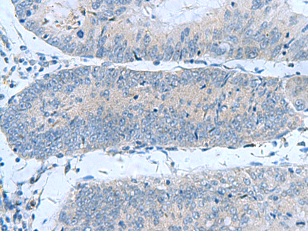 Immunohistochemistry of paraffin-embedded Human colorectal cancer tissue  using GUCA1A Polyclonal Antibody at dilution of 1:50(×200)